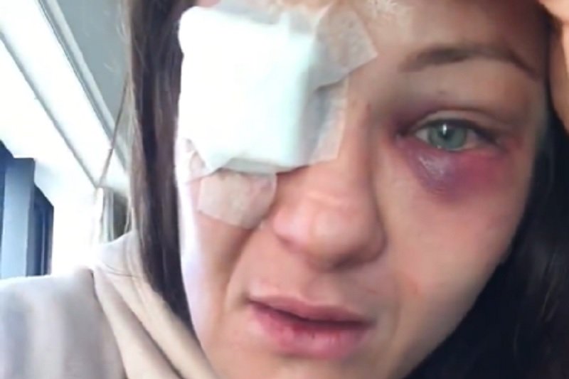 Karolina Kowalkiewicz doznała groźnej kontuzji oka podczas walki w Auckland.