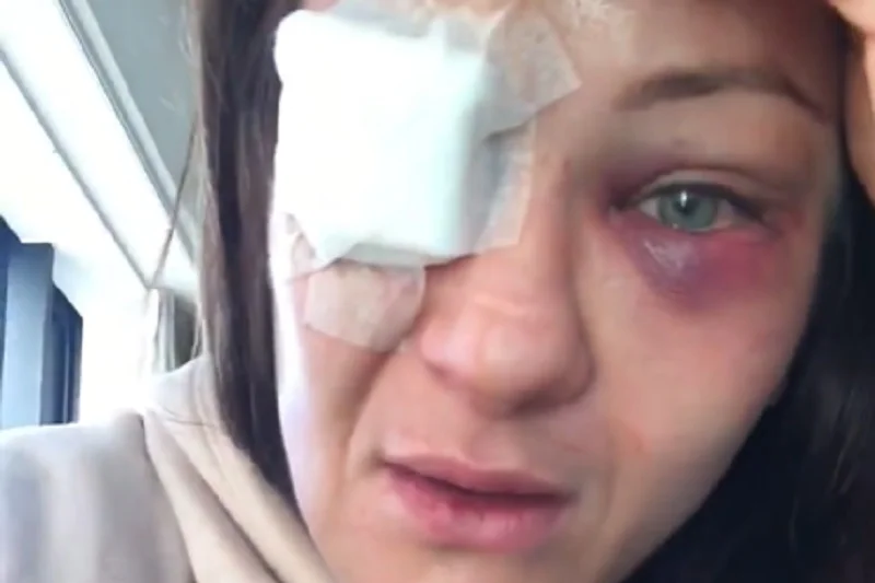 Karolina Kowalkiewicz doznała groźnej kontuzji oka podczas walki w Auckland.