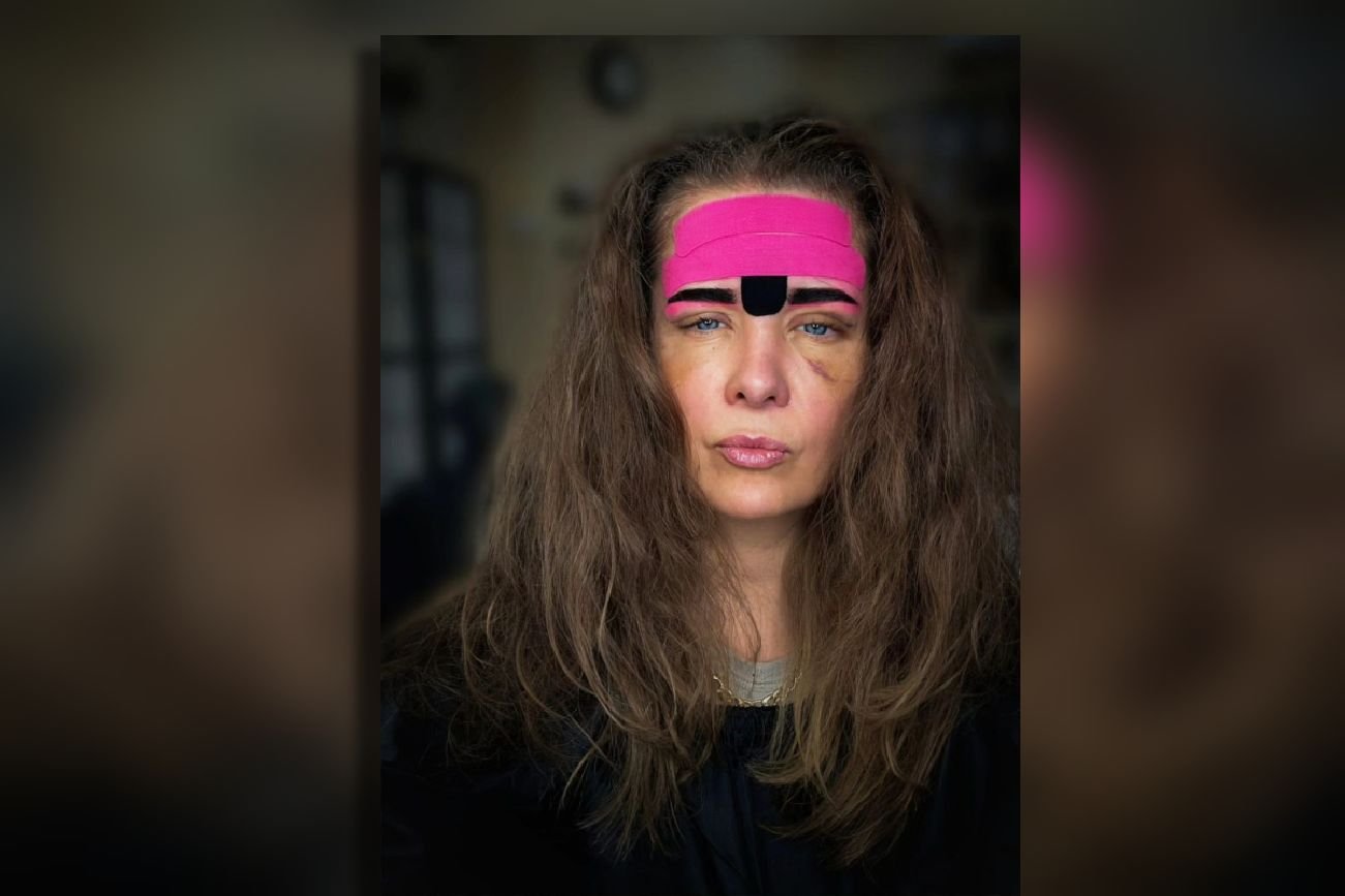 Anna Powierza opublikowała zdjęcie z siniakami