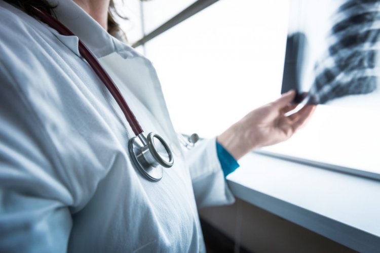 W drobnokomórkowym raku płuca czas jest na wagę złota.