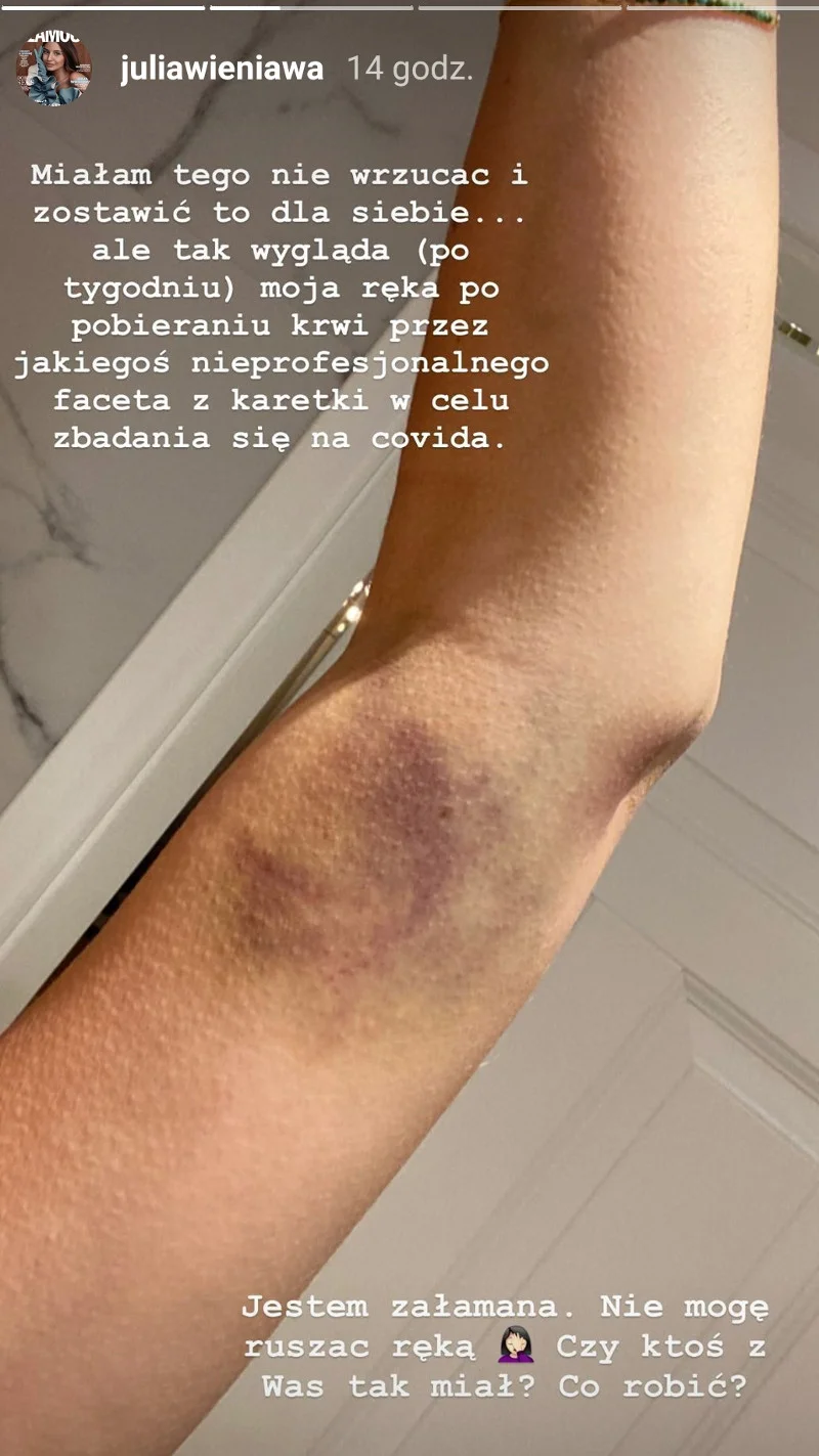 Julia Wieniawa uważa, że siniak powstał z powodu nieprofesjonalnego pobrania krwi.