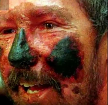 Beck Weathers po powrocie z everestu.