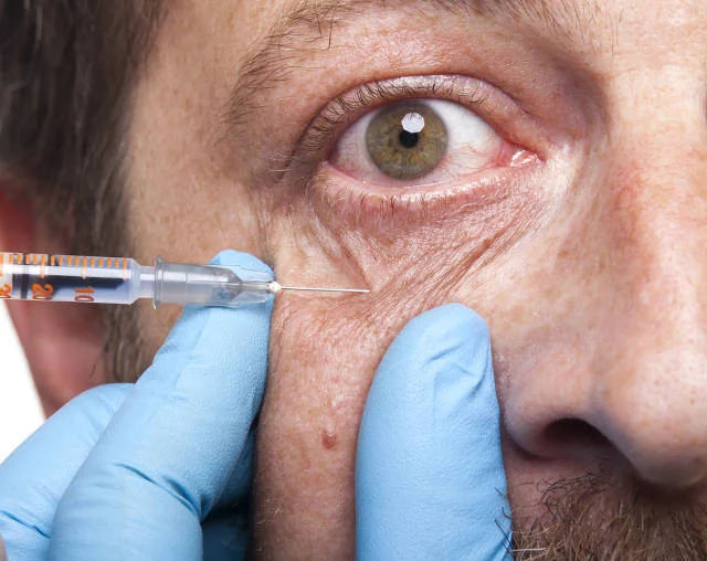 Wypełnianie tzw. doliny łez odmładza. O ile zabieg jest wykonany prawidłowo
