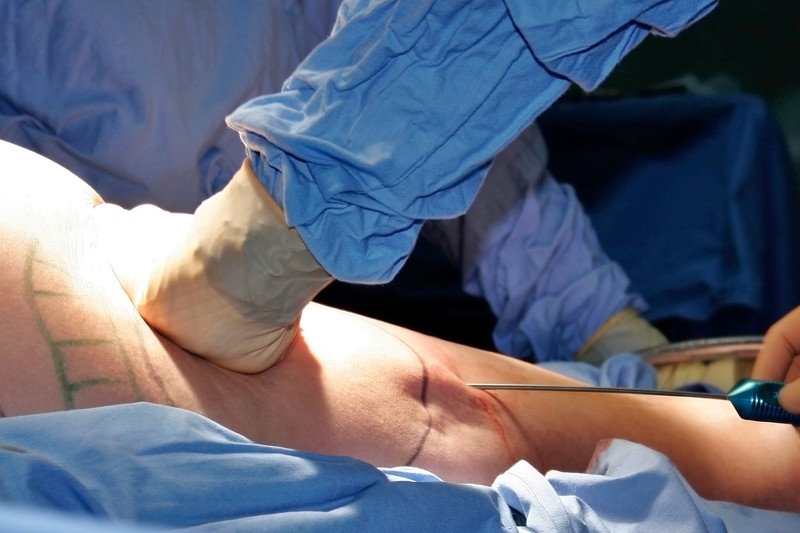 Na zdjęciu zabieg liposukcji.