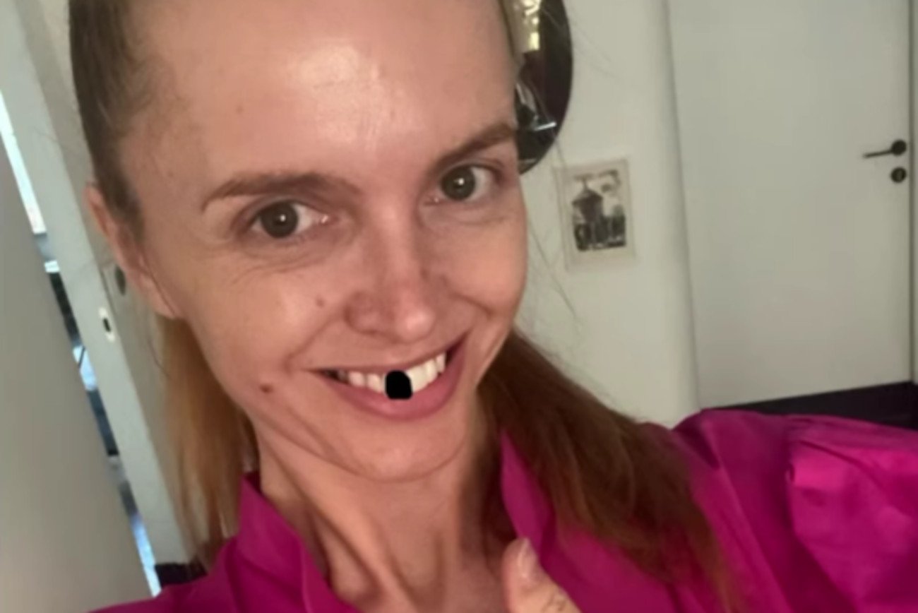 Straciła zęba na wizji, a tłumaczy, jak do tego doszło.