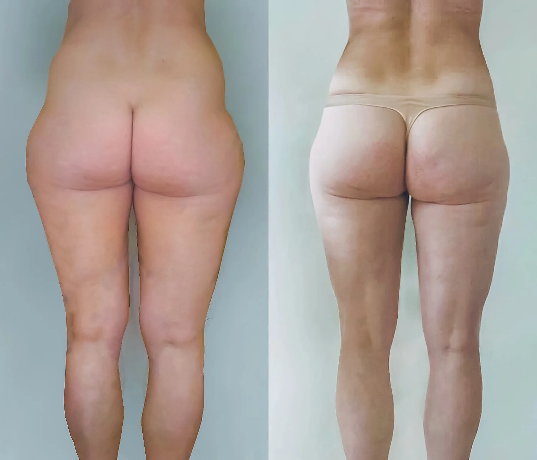 Liposukcja: zdjęcia przed i po zabiegu