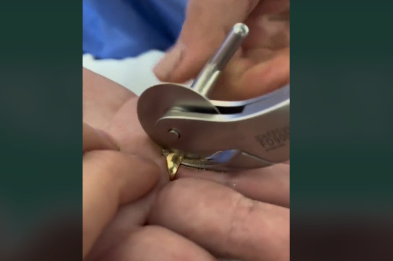 Awaryjne ściąganie obrączki. To dlatego czasem warto je zdejmowa.