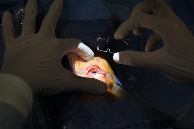 Operacyjne leczenie jaskry.