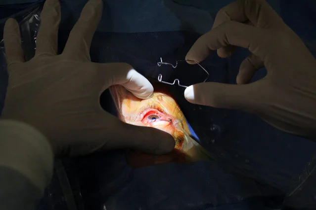 Operacyjne leczenie jaskry.