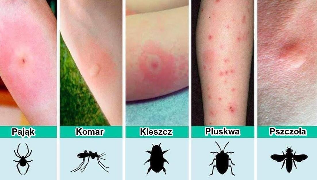 Jak wygląda bąbel po ukąszeniu komara, kleszcza, pająka, pszczoły i pluskwy? Domowe sposoby na leczenie swędzących wykwitów skórnych.