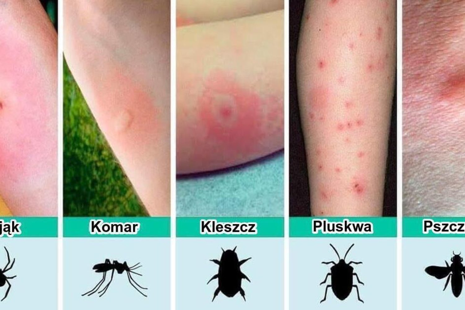 Jak wygląda bąbel po ukąszeniu komara, kleszcza, pająka, pszczoły i pluskwy? Domowe sposoby na leczenie swędzących wykwitów skórnych.