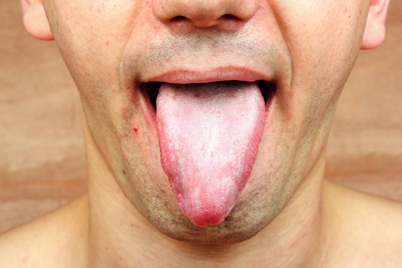 Jednym z najczęstszych objawów towarzyszących grzybicy Candida jest biały nalot na języku...