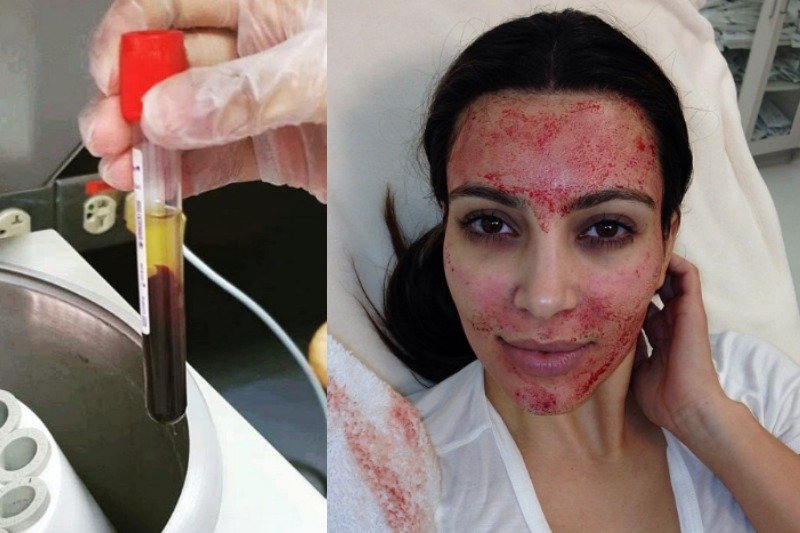 Wampirzy lifting to zabieg, który lata temu wypromowała Kim Kardashian. Teraz okazuje się, że może nieść ryzyko zakażenia m.in. wirusem HIV i żółtaczką typu B i C