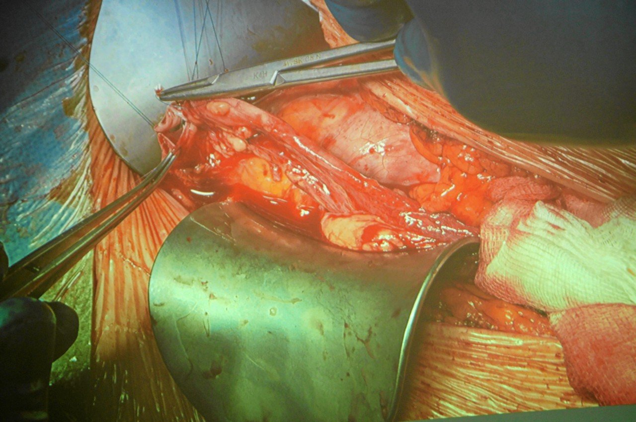 To ostre uszkodzenie nerek najbardziej zwiększa ryzyko śmiertelności przez covid-19.