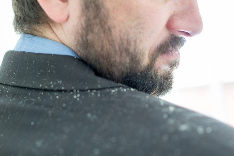 Łupież to problem wyjątkowo nieestetyczny. Widać go na włosach, głowie i ubraniach osoby, której ten problem dotyczy