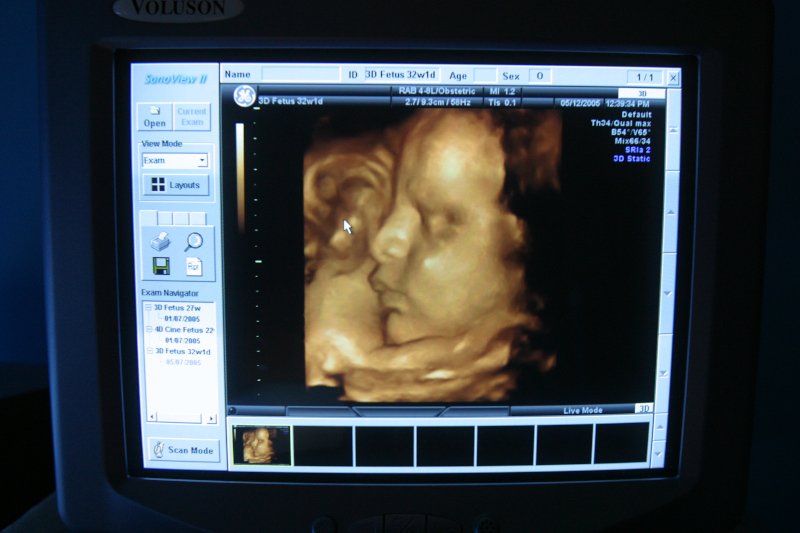 Każda kobieta, która jest w ciąży, musi mieć trzy razy wykonane w tym czasie badania prenatalne.