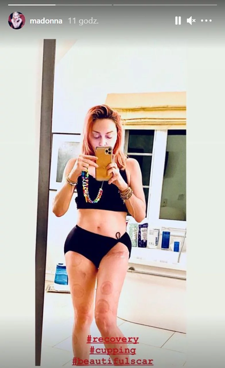 Co prawda instastories z blizną zniknęły już z konta piosenkarki, ale z pewnością pojawią się następne - to nie pierwszy raz, gdy Madonna prezentuje swoją bliznę