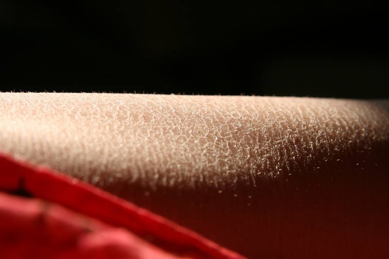 Sucha skóra to problem, na który sezon rozpoczyna się wraz z sezonem grzewczym. Warto o nią teraz zadbać, żeby mu zapobiec