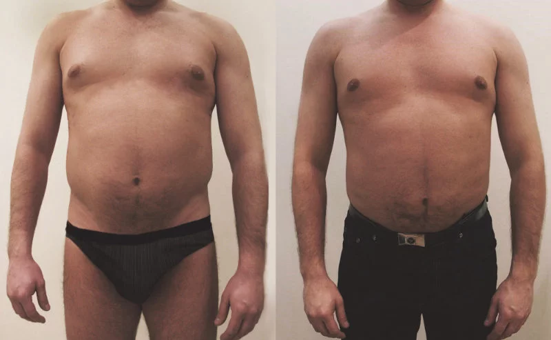 Liposukcja: zdjęcie przed i po zabiegu