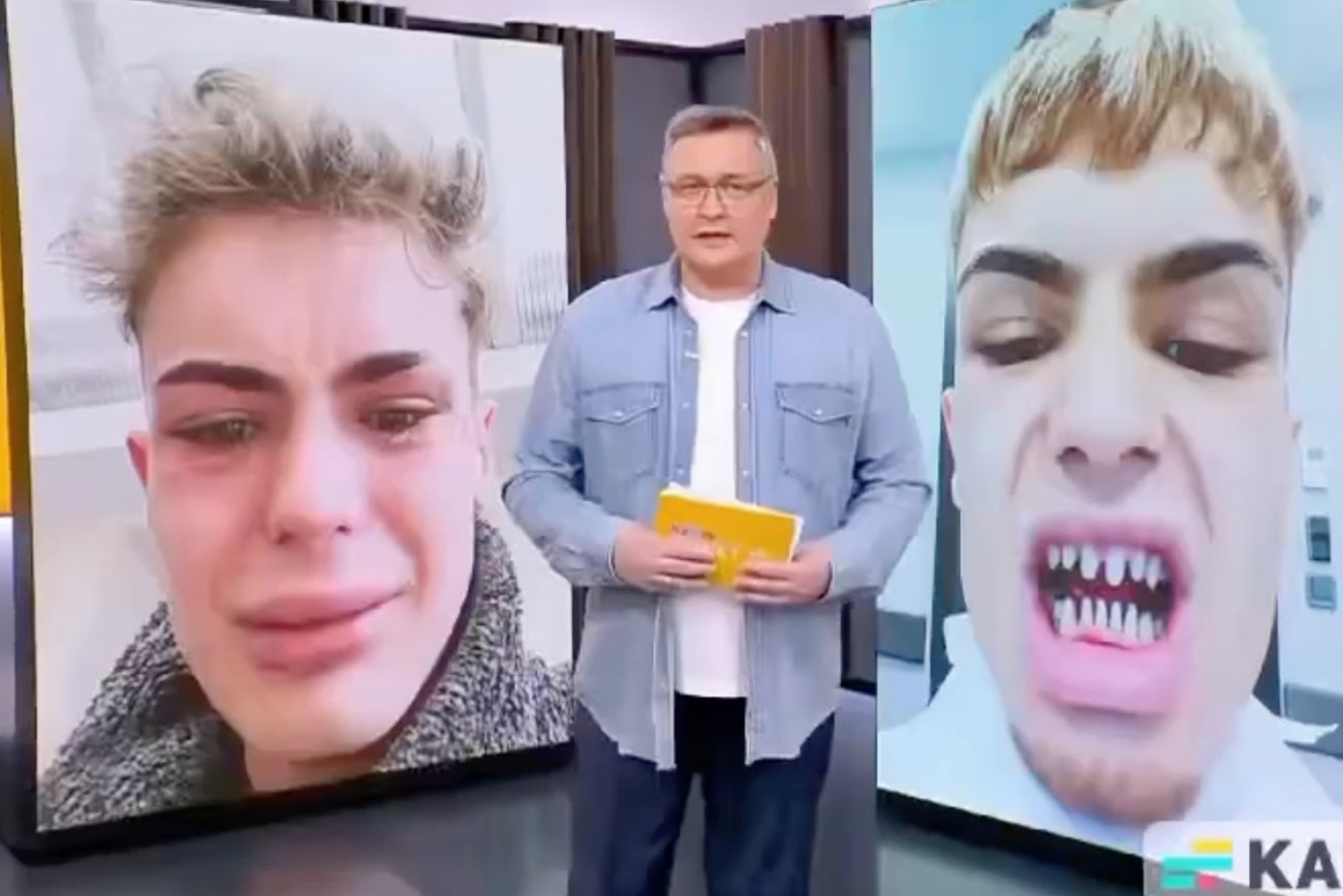 Aspirujący model zrobił zęby w Turcji. Teraz "wygląda jak rekin" [FOTO]