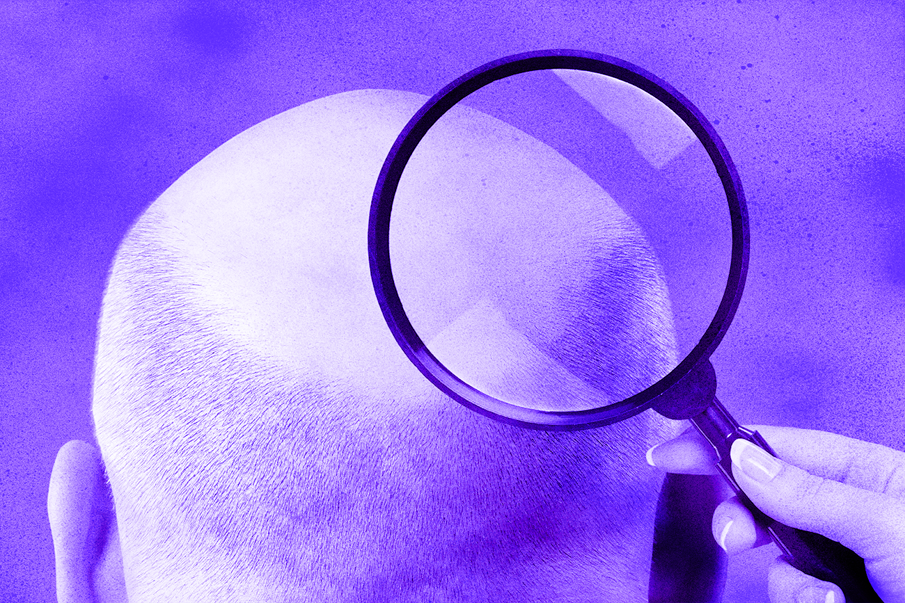 Grafika przedstawia lupę nad łysiejącą głową mężczyzny.