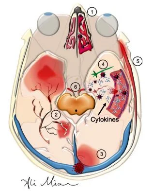 Objawy neurologiczne u pacjentów z covid19 1. Utrata zmysłu powonienia (ansomia). 2. Udar mózgu 3. Zakrzepica żył mózgowych 4. Encefalopatia lub drgawki 5. Zapalenie opon mózgowych 6. Uszkodzenie nerwu czaszkowego. Objawy neurologiczne u pacjentów z covid19 obserwowane w mózgu.