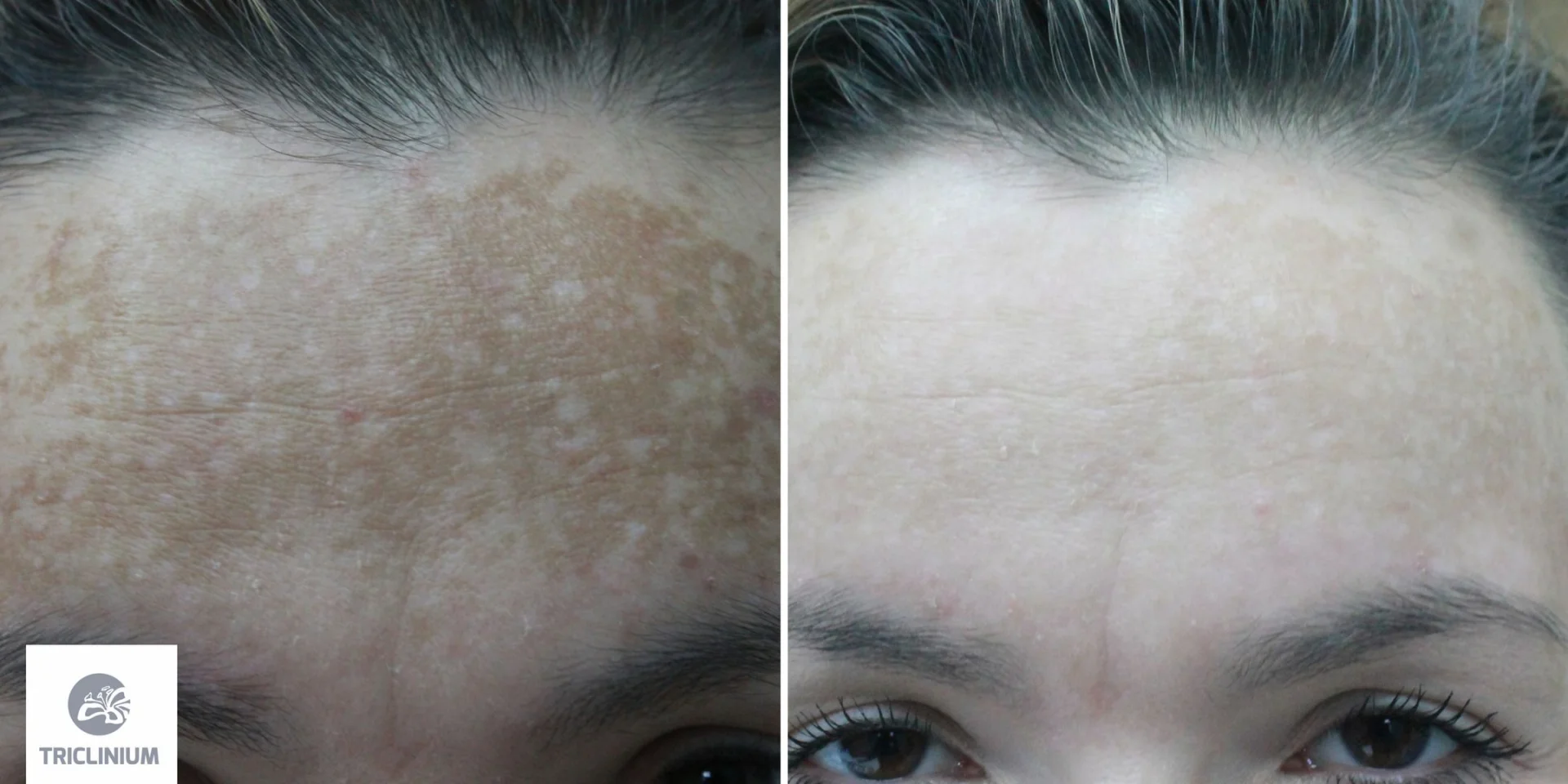 Przebarwienia typu melasma przed i w trakcie terapii - pacjentka po 10 zabiegach laserem bromkowo miedziowym i Q-switch fot. Triclinium