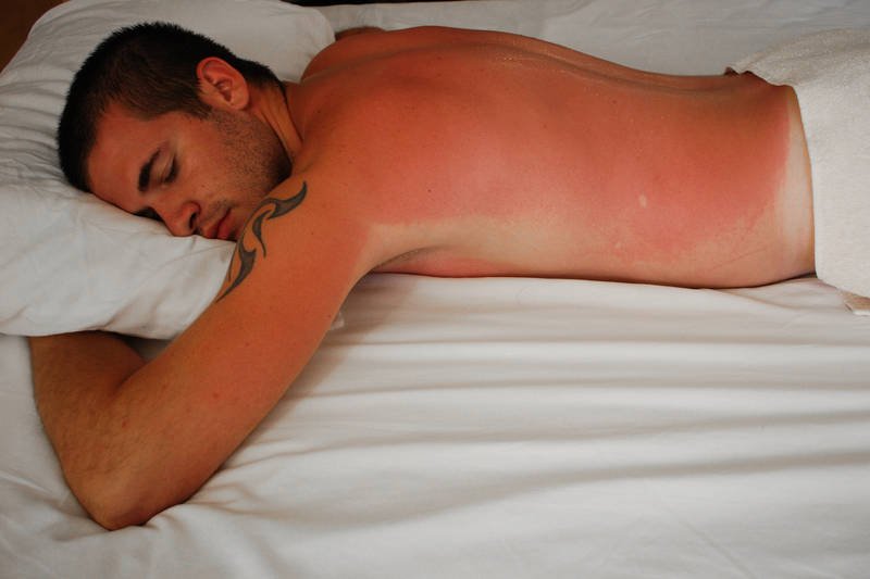 Znacie to? Plecy tak "spalone", że nie da się na nich położyć. Nawet oparcie od krzesła - parzy