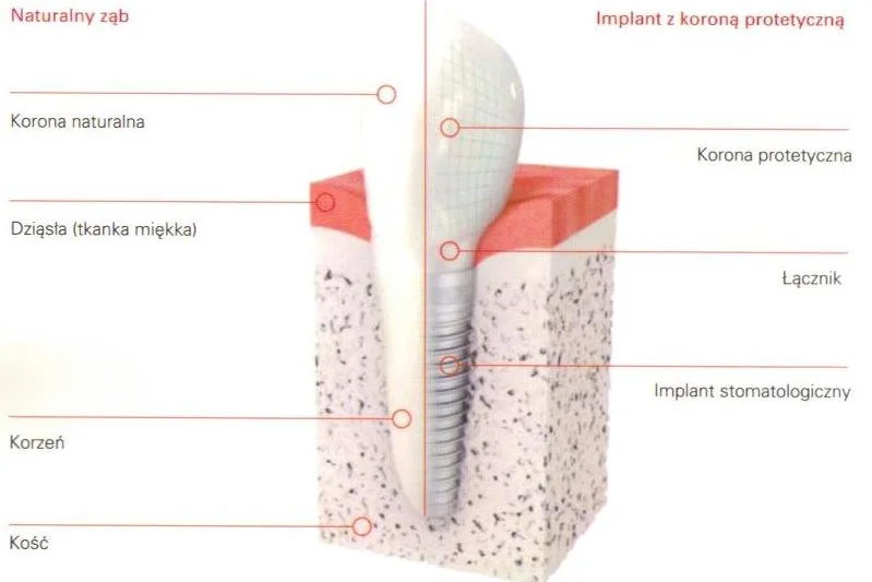 Implant stomatologiczny pełni funkcję podobną do korzenia naturalnego zęba.