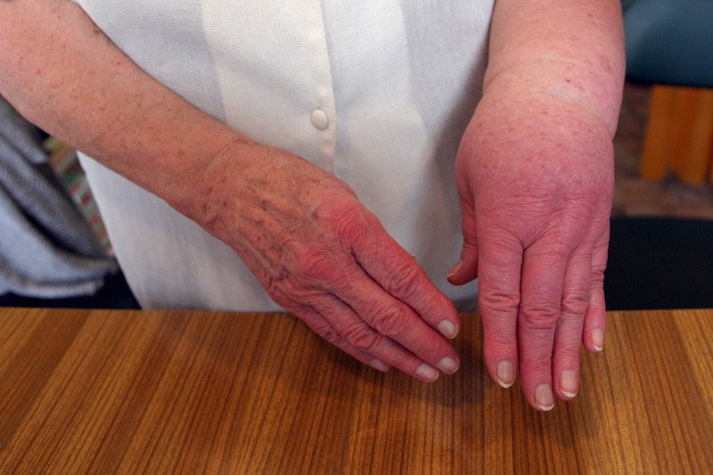 Dziedziczny obrzęk naczynioruchowy (hereditary angioedema, HAE) może prowadzić do śmierci np. przez uduszenie.