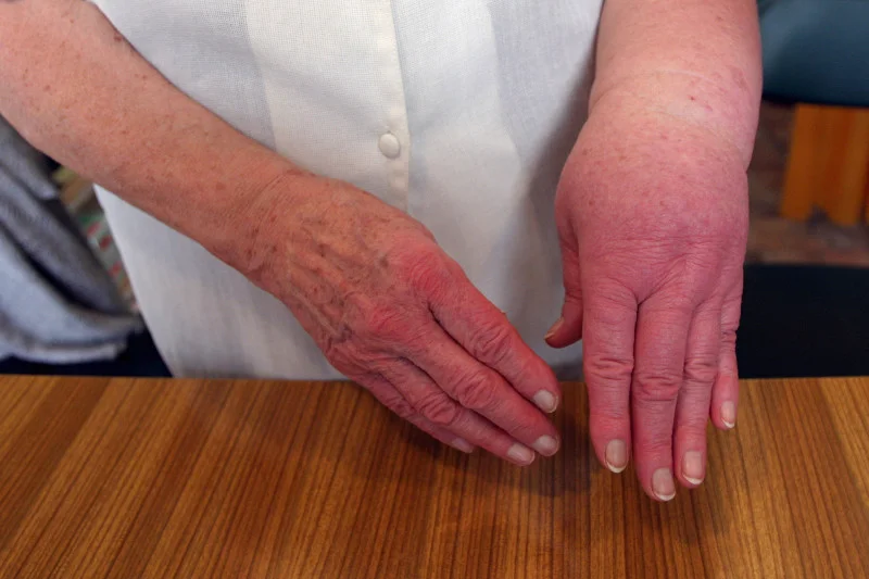 Dziedziczny obrzęk naczynioruchowy (hereditary angioedema, HAE) może prowadzić do śmierci np. przez uduszenie.