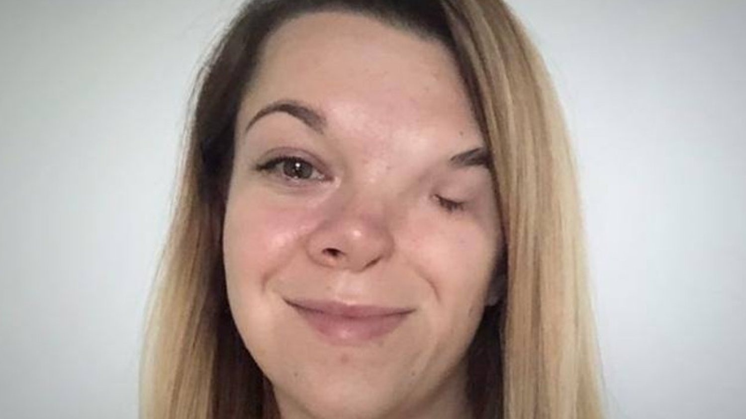 Anna Krawczunas-Kowalczyk potrzebuje operacji rekonstrukcji połowy twarzy.