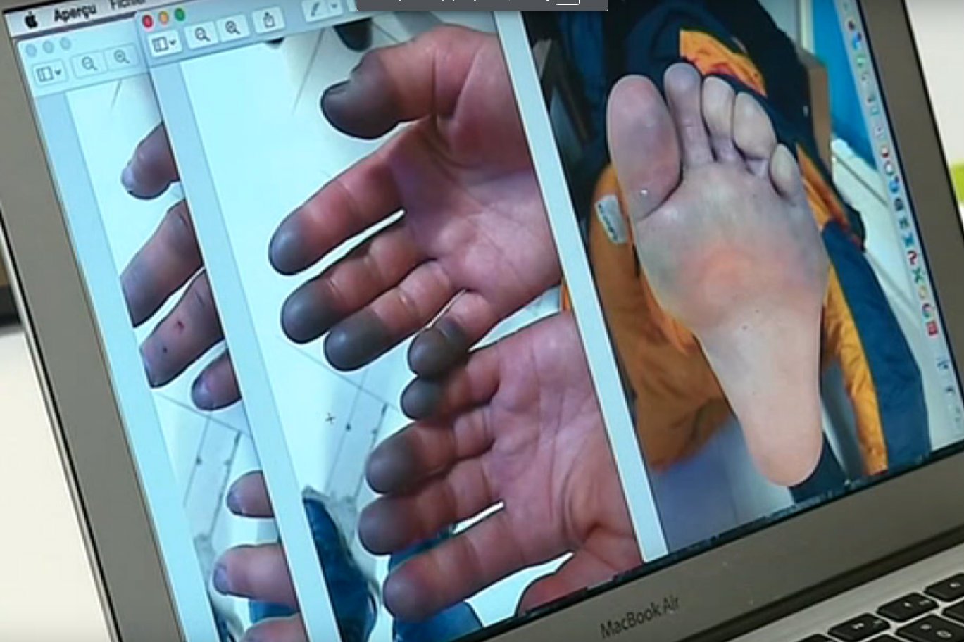 Elisabeth Revol doznała poważnych obrażeń ciała