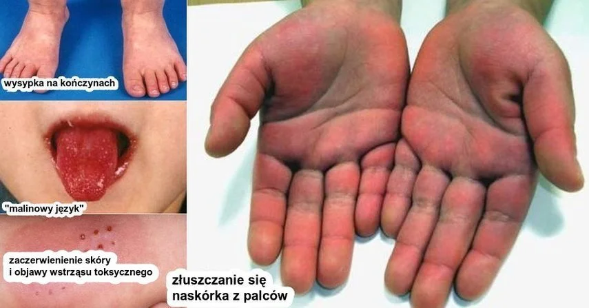 Choroba Kawasaki: objawy, które zdarzają się wśród dzieci zakażonych koronawirusem.