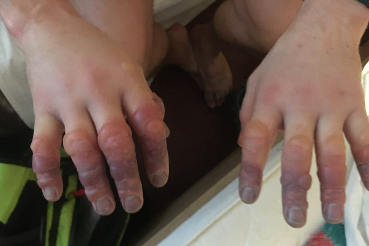 GOPR Bieszczady pokazał zdjęcia odmrożonych rąk turystów po wyprawach w góry.