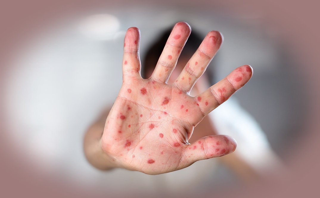 Choroba bostońska ma podłoże wirusowe. Głównie dotyczy dzieci i powoduje charakterystyczne zmiany skórne m.in. na wewnętrznych częściach dłoni.