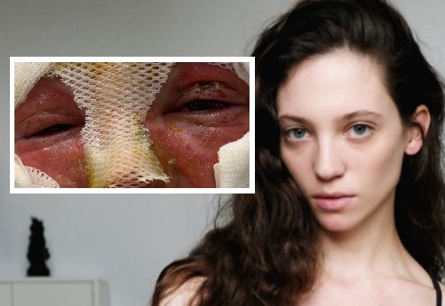 Kuchenka turystyczna wybuchła jej w twarz. Pomoc dla modelki Marii Potoczny