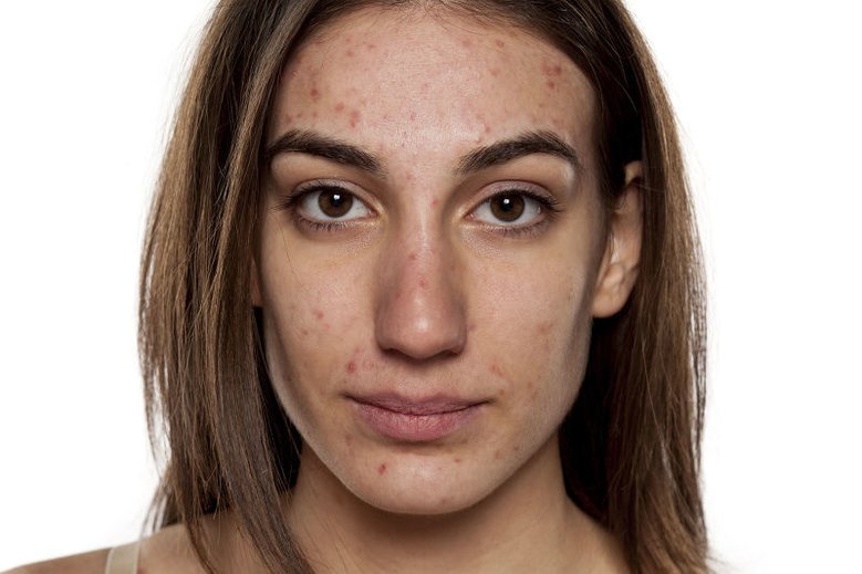 Rozsądna ekspozycja na słońce może łagodzić zmiany trądzikowe.