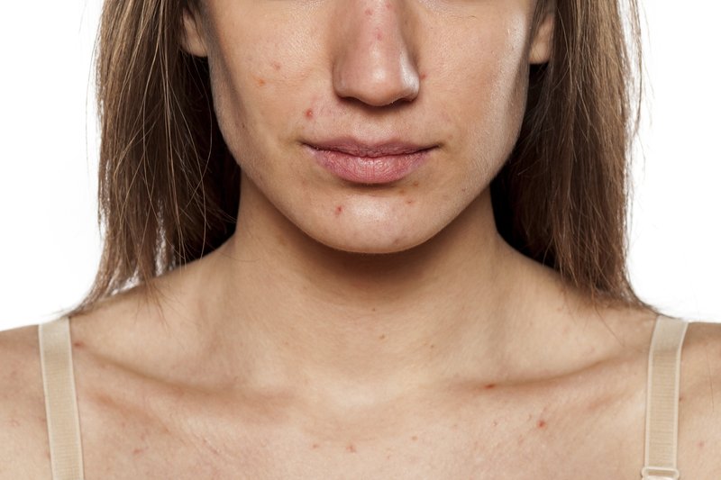 Problemy z trądzikiem nie dotyczą jedynie nastolatków.