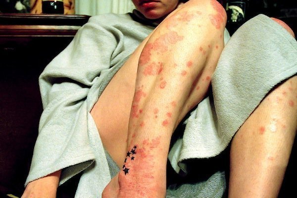 Ponad milion Polaków choruje na łuszczycę. To nie jest choroba zakaźna!