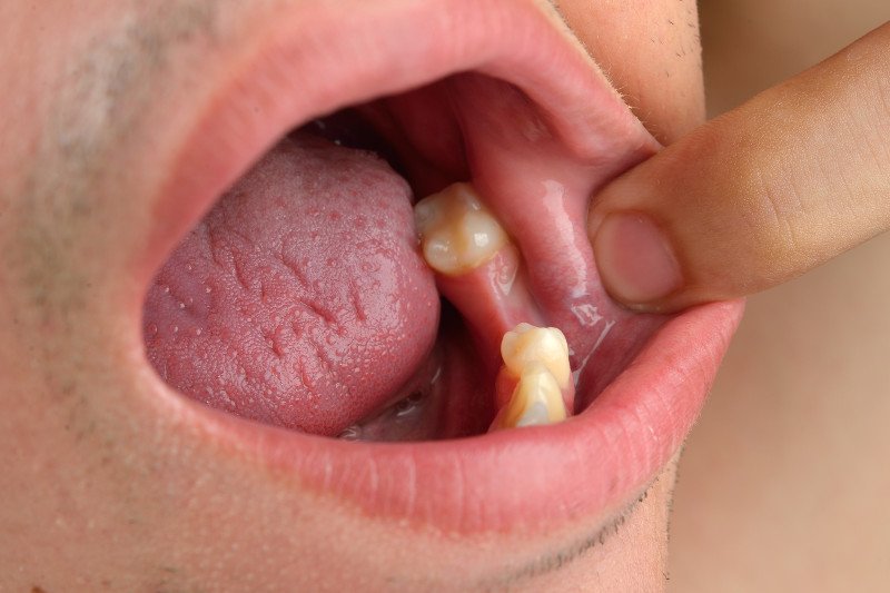 Miejsce po usuniętym zębie nie zawsze goi się bez problemów.