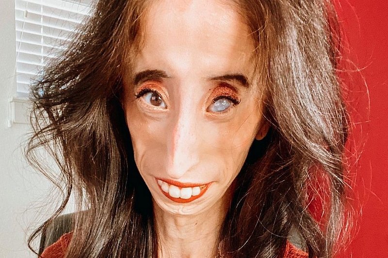 Lizzie Velásquez musi jeść posiłki co 15 minut, aby przeżyć.