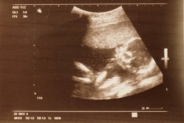 Do Sejmu trafił kolejny antyaborcyjny projekt