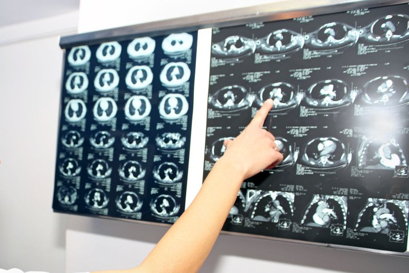 Wczesne zdiagnozowanie raka płuca może uratować życie.