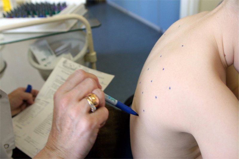 Test alergiczny nie jest bolesny.