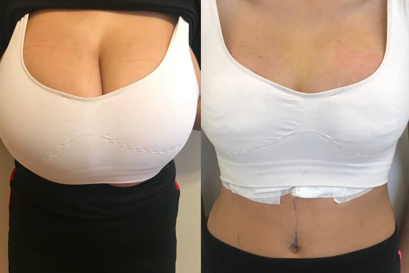 Przerost piersi może utrudniać życie nawet w bardzo młodym wieku. Na zdjęciu efekty operacji u 14 letniej dziewczynki