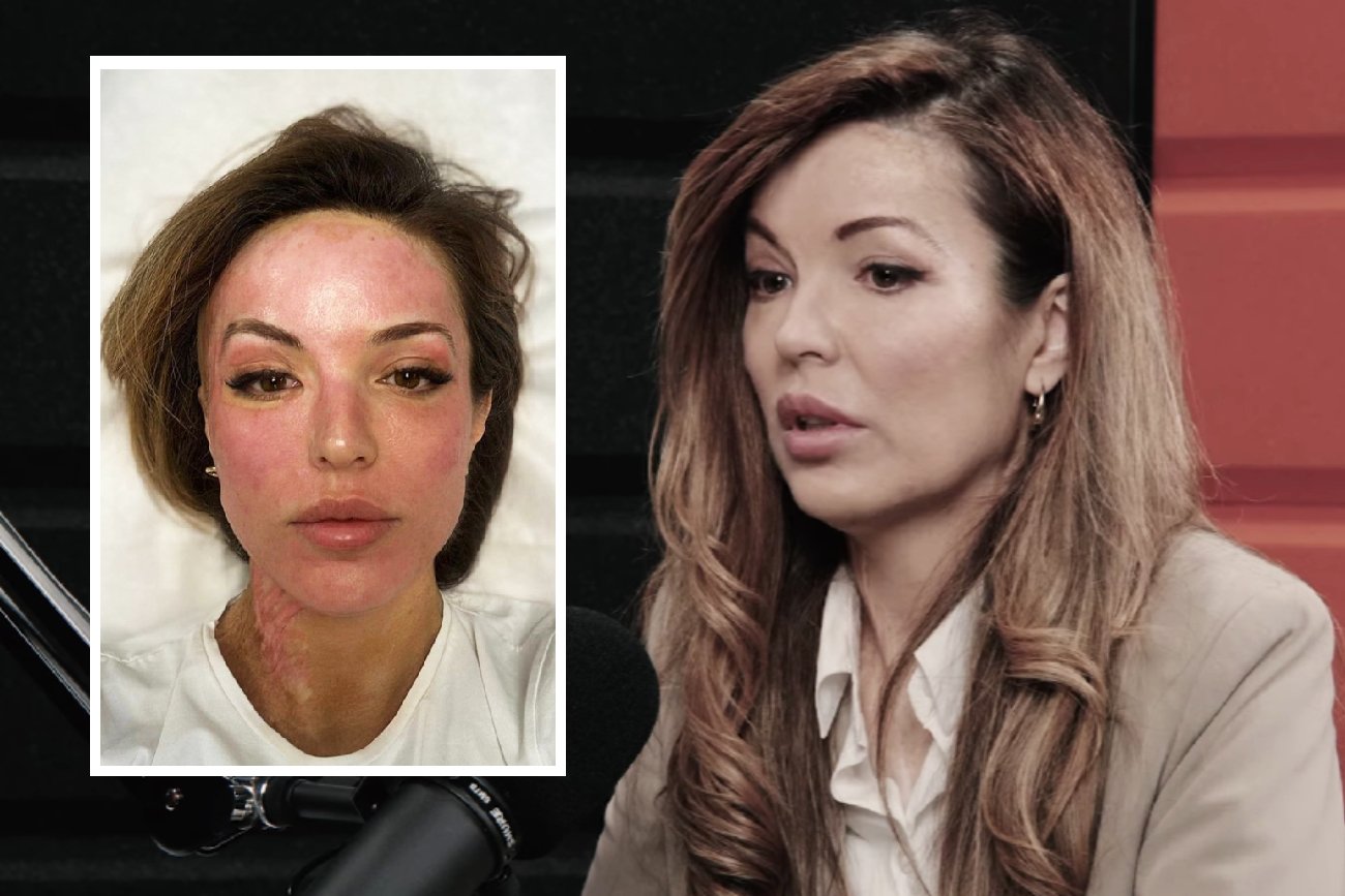 Katarzyna Dacyszyn oblana kwasem przez stalkera. Przechodzi kolejne zabiegi