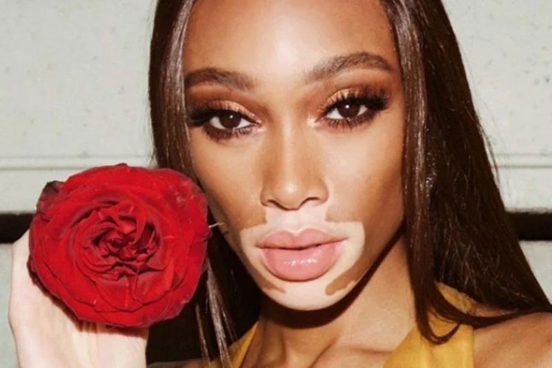 Winnie Harlow wykorzystuje swoje przysłowiowe pięć minut w świecie mody