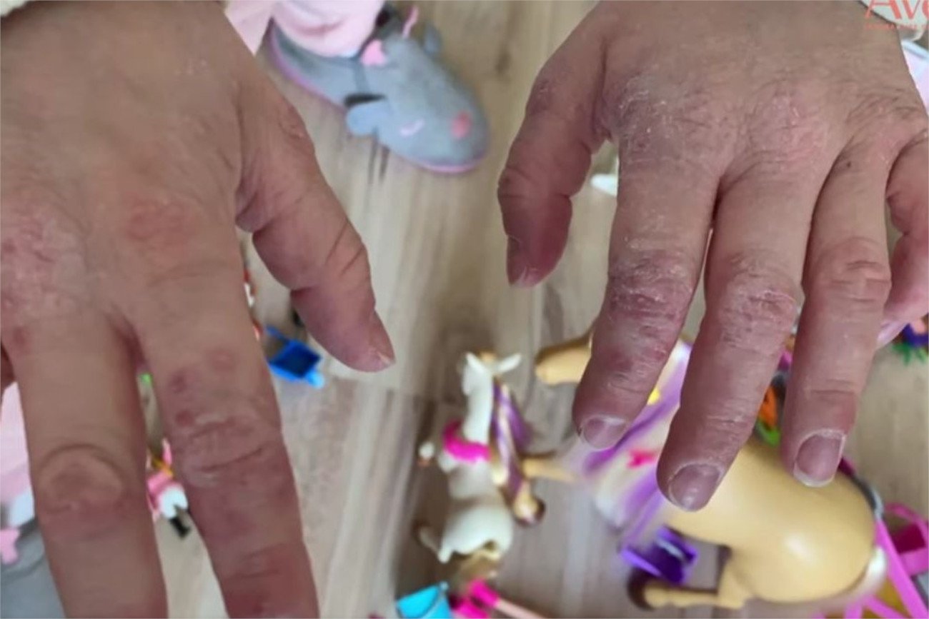 AZS nawet w nocy daje o sobie znać. Skóra, która nieustannie swędzi, nie daje zasnąć.