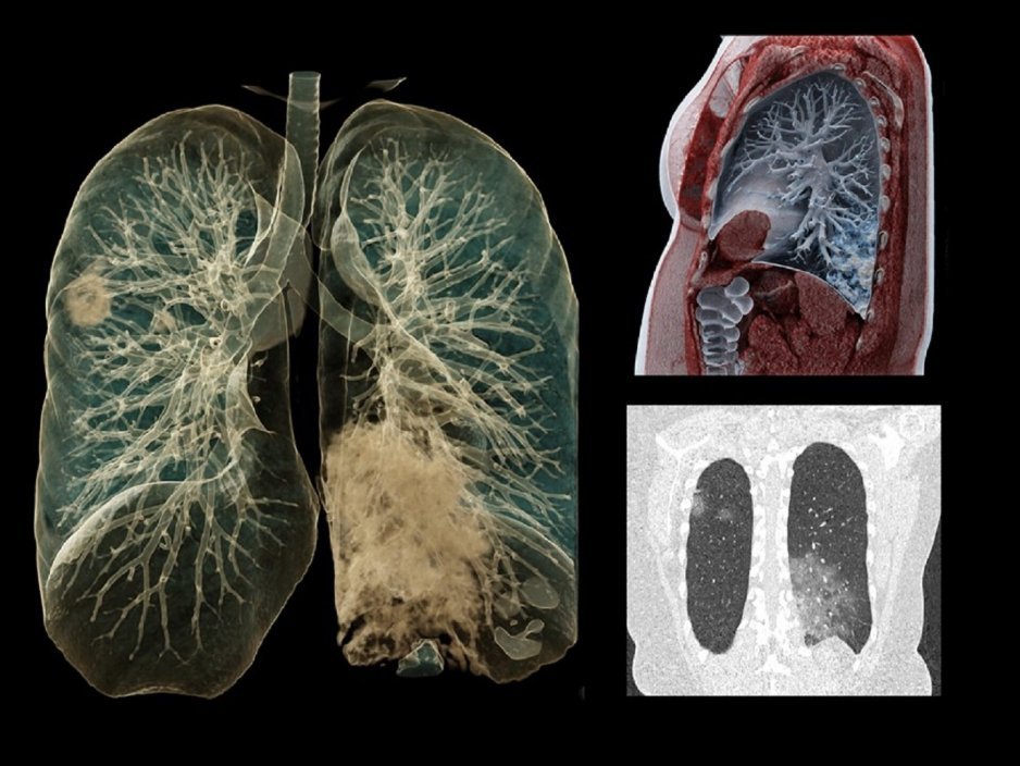 U osób, które przeszły COVID-19 łagodnie, lekarze diagnozują poważne zmiany m.in. w płucach. / Zdjęcie ilustracyjne